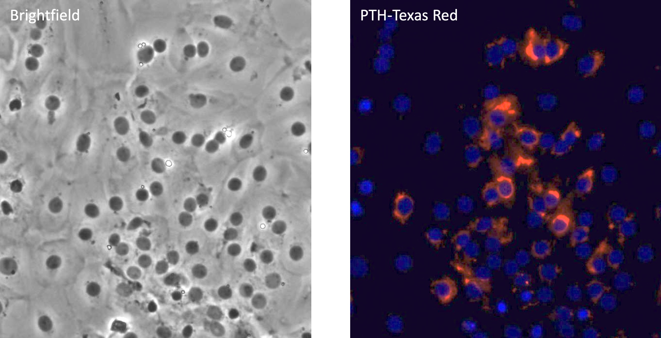 Staining of primary parathyroid cells after 4 hours of low calcium stimulation. Same field is shown on left (brightfield) and right (immunofluorescence for PTH in red, DAPI in blue). Images by Betty R. Lawton Ph.D.